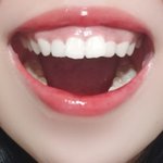 잇몸때매 미칠 것 같다 ㅋㅋ