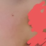 [개깊은빡침] 진짜 겨울 되니깐 <b>홍조</b> 넘힐들다 ㅠ