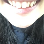 <b>앞니</b> 벌어진거 심해??