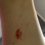 아뉘 다리털 눈썹 그거로 밀다가 상처남