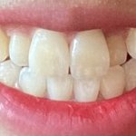 [댓글부탁해] <b>덧니</b> 나보다 심한애 없을듯