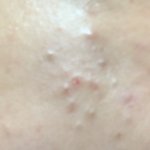 [조언부탁해] 여드름 진짜 개패고싶어 <b>좁쌀</b> 다 밀고 싶다