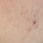 <b>미방</b> 없음 ) 얘들아 극혐인데 이거 여드름 짜서 이런거임?