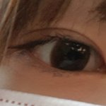 쌍수한지 3달 ?4달?<b>지남</b>