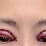 [이것좀봐줘] 쌍수 이런적있으세요?