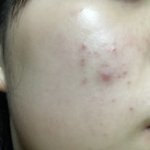[드루와] <b>염증</b>주사 맞아야해??