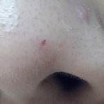 [19] +얘들아 나 <b>코에</b> 피지짰는데 어캄???