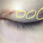 쌍수 <b>실밥</b> 풀고 왔는데 뭐야 이거..???