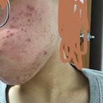 [조언부탁해] 내 피부 많이 <b>심해</b>?