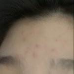 (혐 주의)이런 이마 여드름 <b>자국</b> 어캐 없앰?
