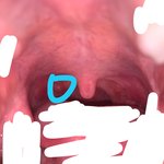 [이것좀봐줘] 이거 <b>편도</b>결석 맞나요?