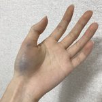얘들아 손 이 부분 멍들었는데 어떡하지