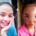 10대 여성 뾰루지 짰다가 혹으로 뒤덮인 얼굴…"도와주세요"