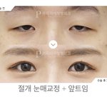 나 쌍수하는 병원에서