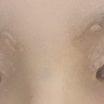 <b>매몰</b>쌍수 2일차인데 원래 붓기 이런가요?