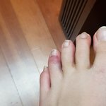 나<b>발가락</b>부딪혓는데이거골절임??ㅠ