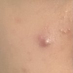 [댓글부탁해] 여드름 가라 앉히는 법 좀 ㅠ