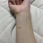 <b>화상</b> 입었는데 이거 흉 지려나?