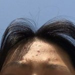 [드루와] <b>이마</b> 여드름 거의업ㅎ어짐