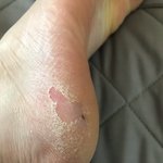 내 <b>무좀</b>에 대해 어떻게 생각하냐