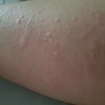 [방탈죄송] 이유모를엄청난두드러기(사진있어요혐