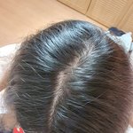 <b>탈모</b>맞죠?