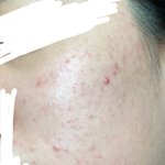 [댓글부탁해] 내 피부 조언 좀 해줘 죽고싶어