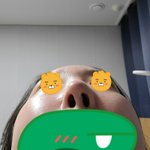 [<b>성형</b>] <b>코성형</b>1년차