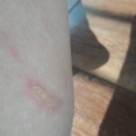 화상<b>물집</b> 병원가야될 거 같아??