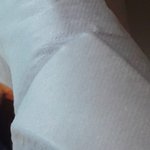 얘들아 나 다리에 화상<b>입음</b>