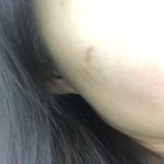 [댓글부탁해] 여드름 <b>흉터</b> 없애는 법 좀