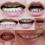 [꼭조언부탁] 제 치아좀 봐주세요2(사진주의)