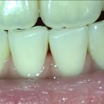 이렇게 <b>이빨사이</b>에 구멍난 건 걍 답없음?