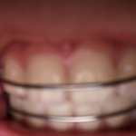 ㅎ<b>미용목적</b>으로 교정하는 애들이 ㄹㅇ ㅂㅅ임