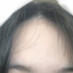 나 <b>이마</b> 개넓음