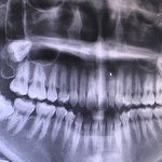 나 사랑니 4개 다있는데 아픈<b>사랑니야</b>?