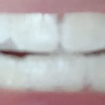 치아<b>미백</b> 하는 중