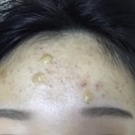 개극혐주의) 나 여드름 <b>압출</b>받고 이렇게 됐는데