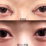 이렇게 쌍수 할 수 있냐