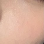 [혐주의] 나 피부과 한번 더 <b>갈만</b>한것같아ㅠㅠ??