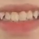 나 <b>송곳니</b> 어캄 ㅠㅠ
