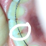 <b>치석</b> 이거 바로 가서 제거해야할정도냐