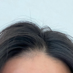 20대 초반인데 탈모로 고생중 (+정보공유하자)