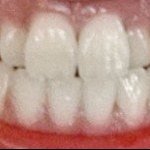 [댓글부탁해] <b>덧니</b> 어때