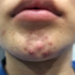 <b>시카</b>크림으로 트러블 완화 후기!(사진 ㅇ)