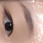 쌍수 고민