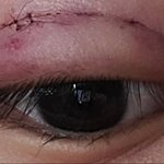 [댓글부탁해] 약혐) <b>쌍수</b> <b>후</b> 이정도 붉은기 정상이야..?
