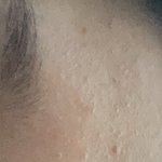 이마 <b>좁쌀</b> 제품 ㅊㅊ좀 ㅜㅜ