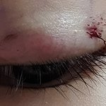 쌍수 재수술 <b>실밥</b>풀린거야?