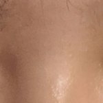 쌍수 5일차 <b>실밥</b> 풀고 옴